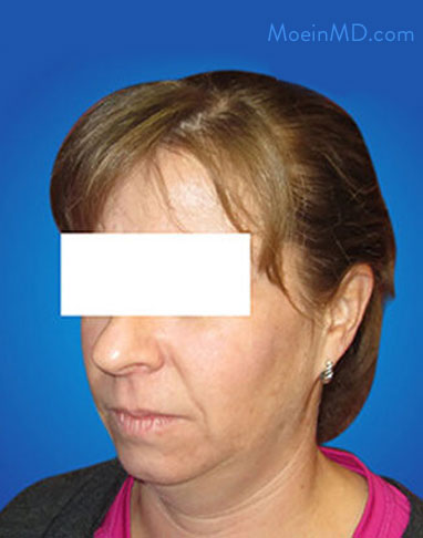 neck lift surgery before