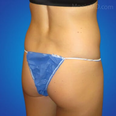 Liposuction butt before