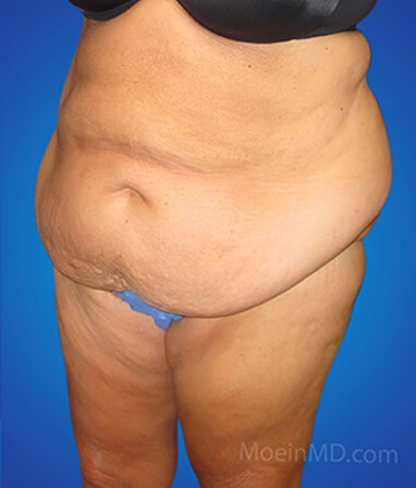 belly liposuction before
