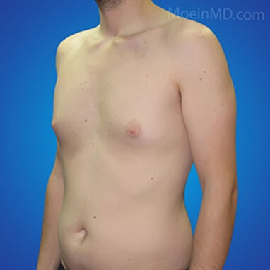 breast reduction for men before