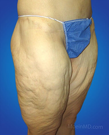 Thigh lift surgery before