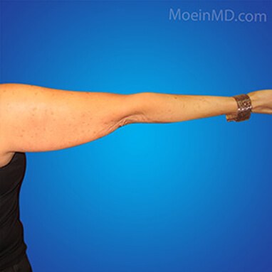 arm fat liposuction