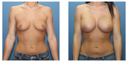 Breast Augmentation Los Angeles CA by dr. Moein