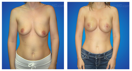 Breast Reduction before and after