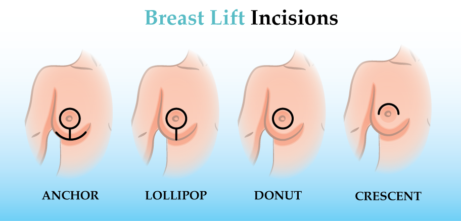 Breast lift Incisions