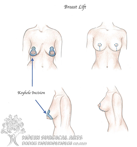 Breast lift