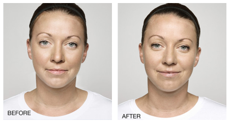 dermal filler injections los angeles