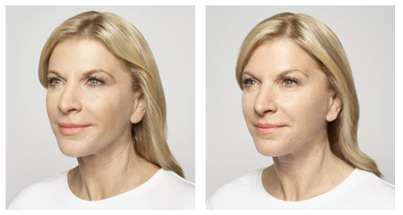 face filler injections los angeles