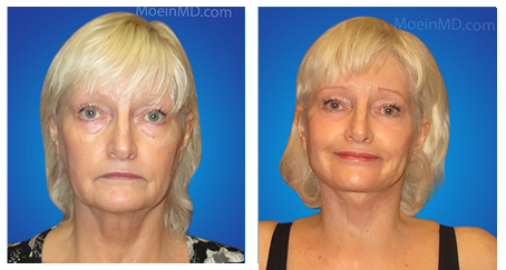Face lift before and after