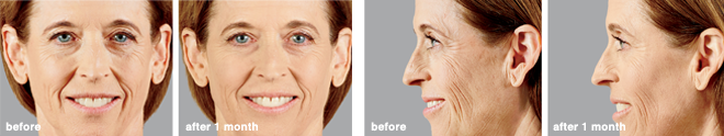 julia_botox