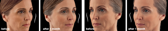 kathy_botox