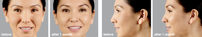 leslie_botox