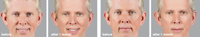 lonny_botox
