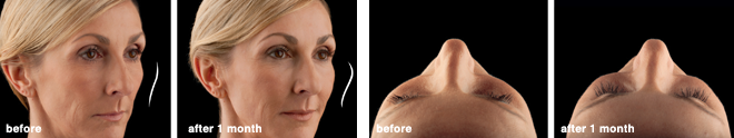 tami_botox