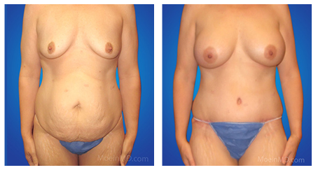 best tummy tuck doctor in los angeles