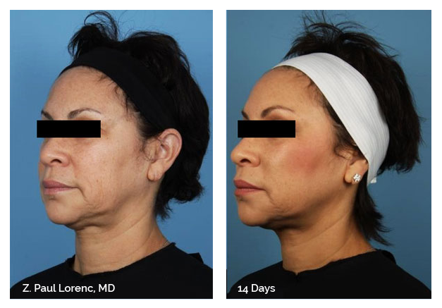Silhouette InstaLift procedure before and after