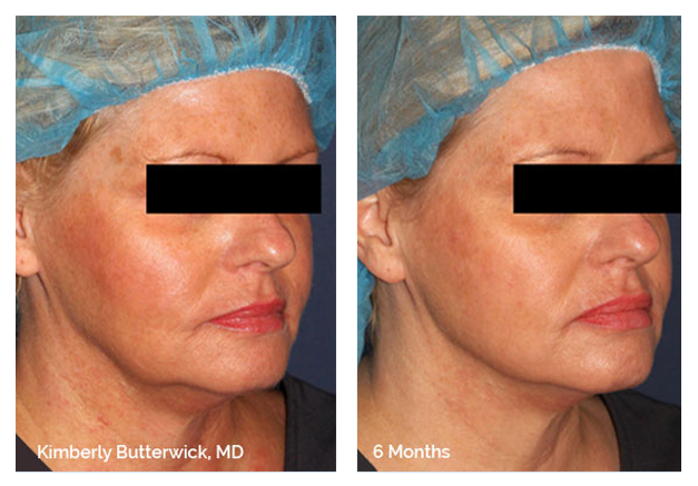 Silhouette InstaLift procedure before and after