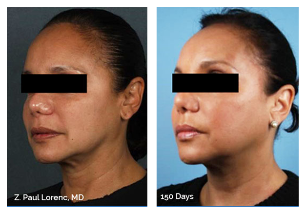 Silhouette InstaLift procedure before and after