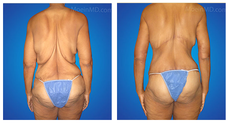 excess skin removal doctor los angeles