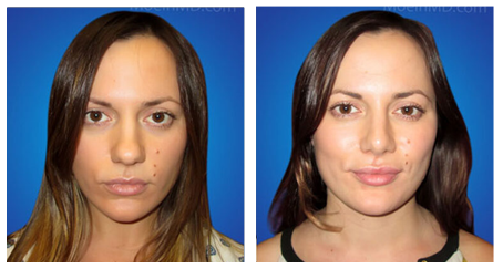 Rhinoplasty before and after