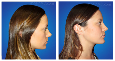 Rhinoplasty before and after