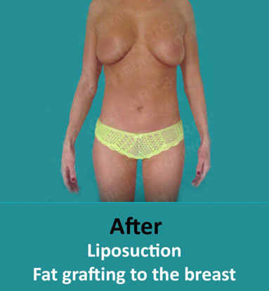 breast fat grafting