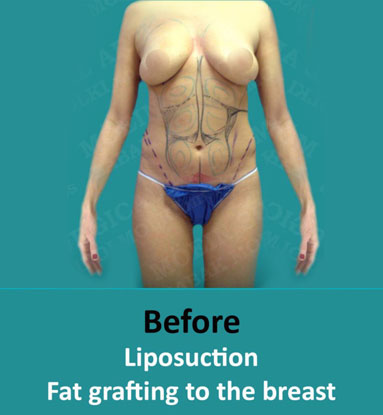 breast fat grafting los angeles