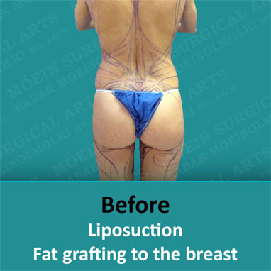 Before liposuction fat grafting to the breast