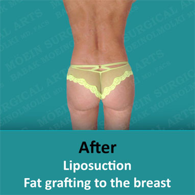 After liposuction fat grafting to the breast