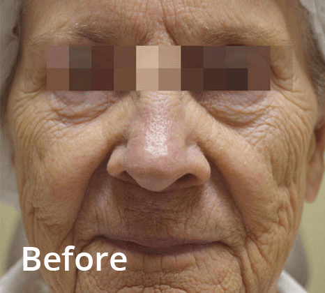 fractora-DrBittar-JSisto-before