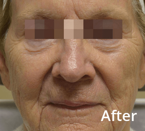 fractora-DrBittar-JSisto-ba after