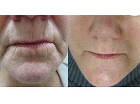 procell MICRONEEDLING BY MOEIN SURGICAL ARTS