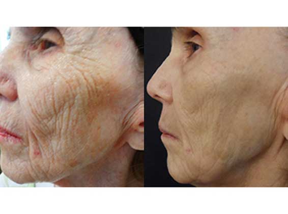 Procell MICRONEEDLING BY MOEIN SURGICAL ARTS