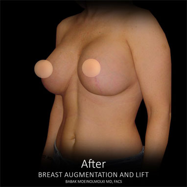 breast lift with breast augmentation after