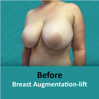 breast augmentation replacement and lift before
