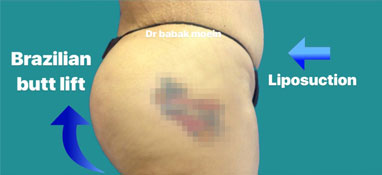 Brazilian but lift after