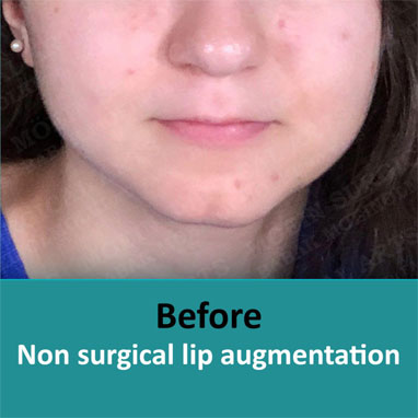 Non surgical dermal filler before