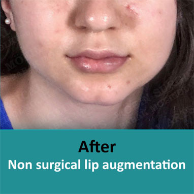 None surgical dermal filler after