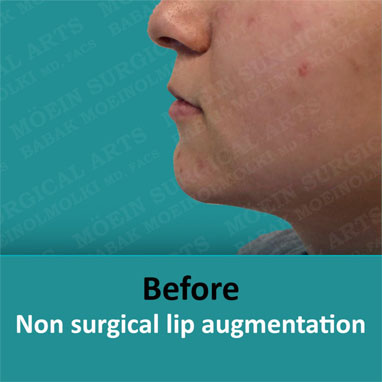 None surgical dermal filler before result