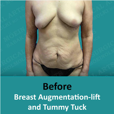 Breast Augmentation-lift before