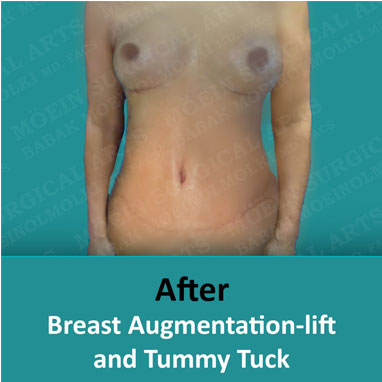 Breast Augmentation-lift after