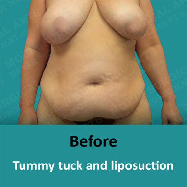 breast reduction and tummy tuck before