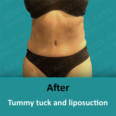 breast reduction and tummy tuck after