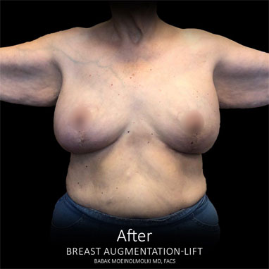 scarless breast lift and augmentation after