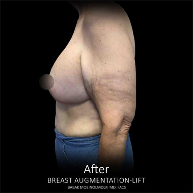 breast augmentation and lift scar after photo