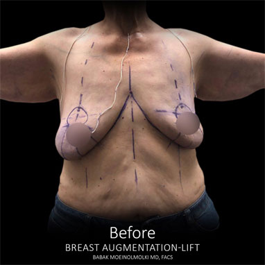 scarless breast lift and augmentation before