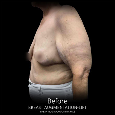 breast augmentation and lift scar before photo