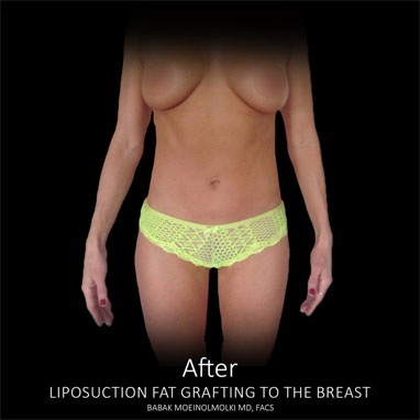 tummy lipo after