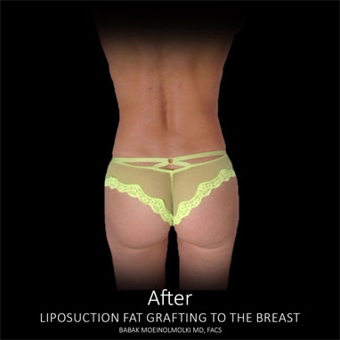 waist reduction surgery after