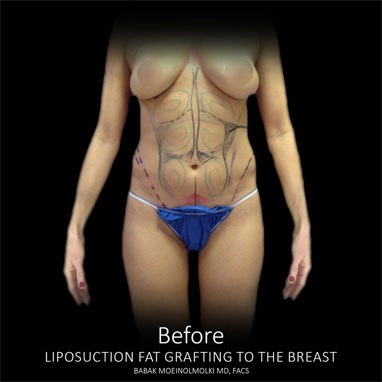 tummy lipo before
